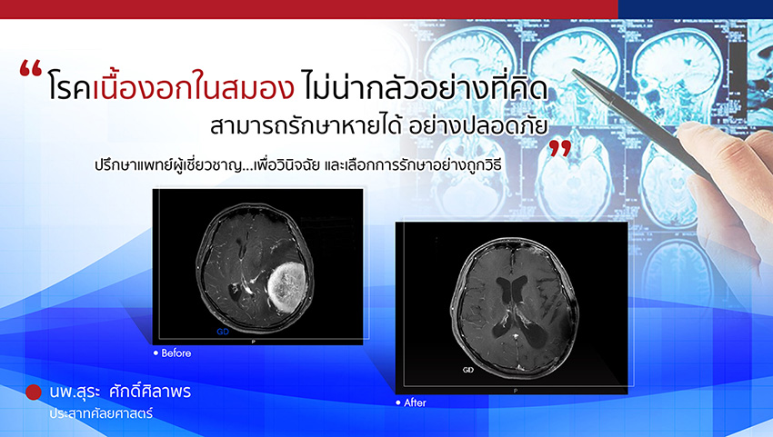 โรคเนื้องอกสมอง